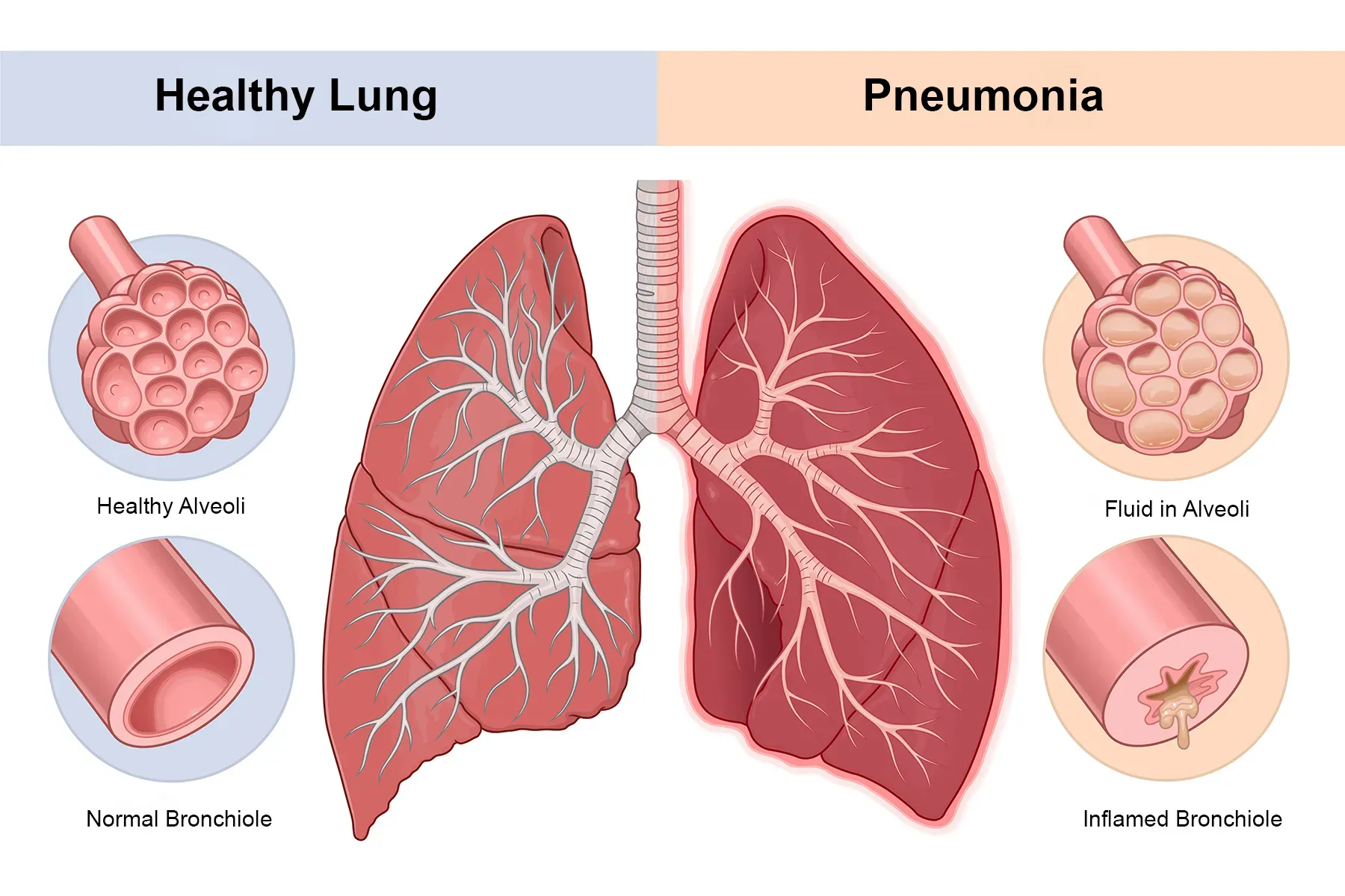 Pneumonia